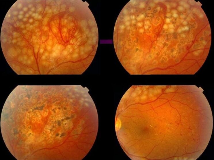 Retinopatía por hipertensión